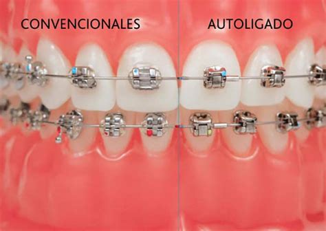 brackets metalicos y autoligables|brackets autoligables diferencias.